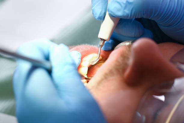 Best Emergency Treatment for Dental Infections or Abscesses in China Spring, TX