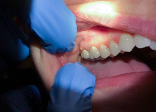 Best Emergency Denture Repair in China Spring, TX